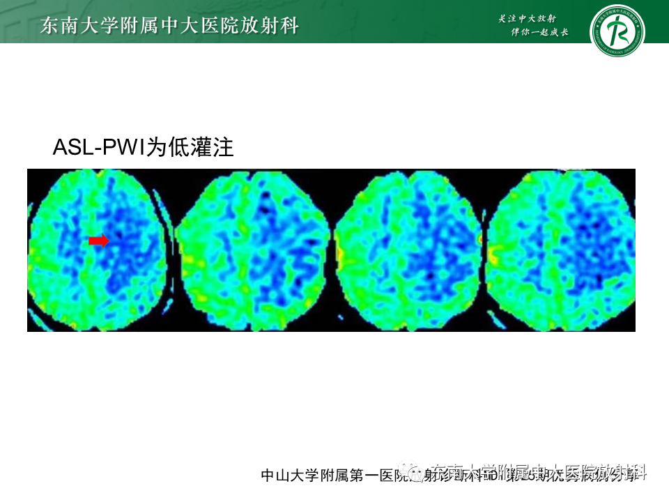 影像PPT - 【PPT】2022.07.08 神经系统疾病——脱髓鞘假瘤-40 影像PPT - 【PPT】2022.07.08 神经系统疾病——脱髓鞘假瘤-40