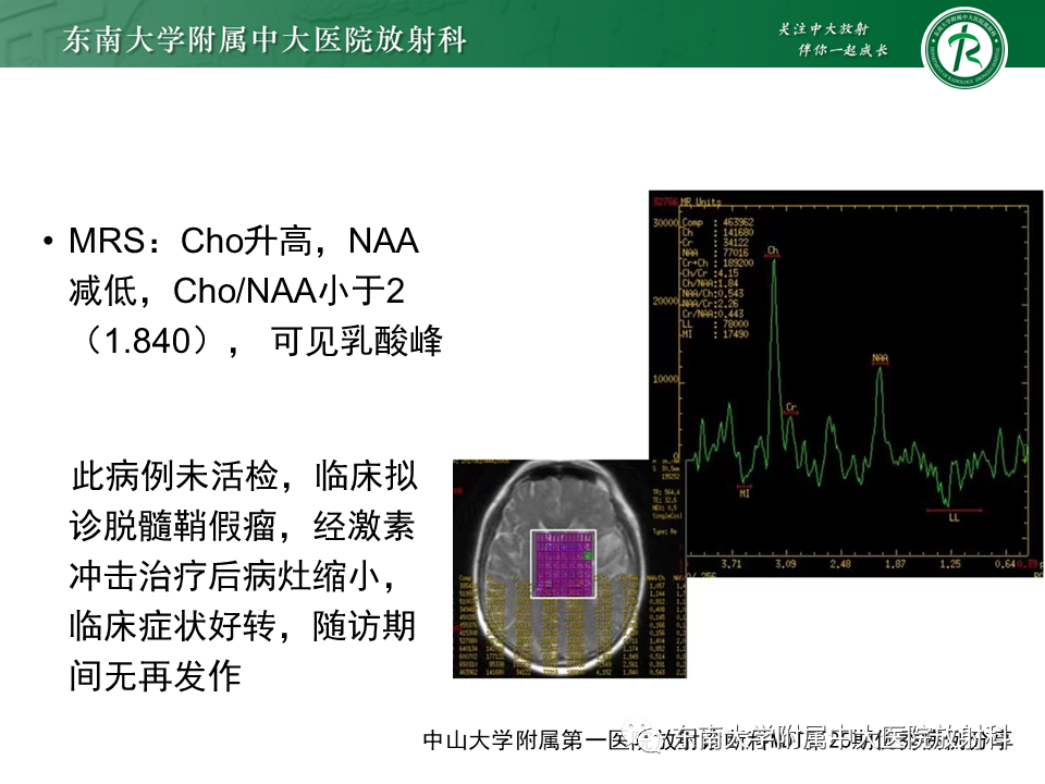 影像PPT - 【PPT】2022.07.08 神经系统疾病——脱髓鞘假瘤-41 影像PPT - 【PPT】2022.07.08 神经系统疾病——脱髓鞘假瘤-41