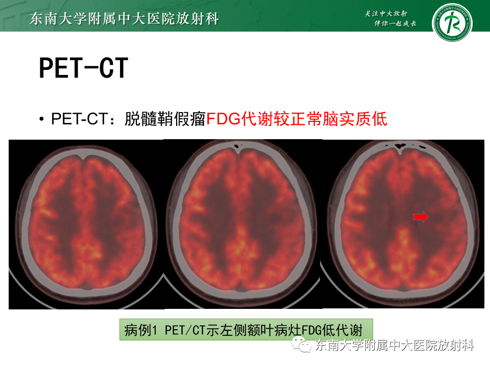 影像PPT - 【PPT】2022.07.08 神经系统疾病——脱髓鞘假瘤-43 影像PPT - 【PPT】2022.07.08 神经系统疾病——脱髓鞘假瘤-43