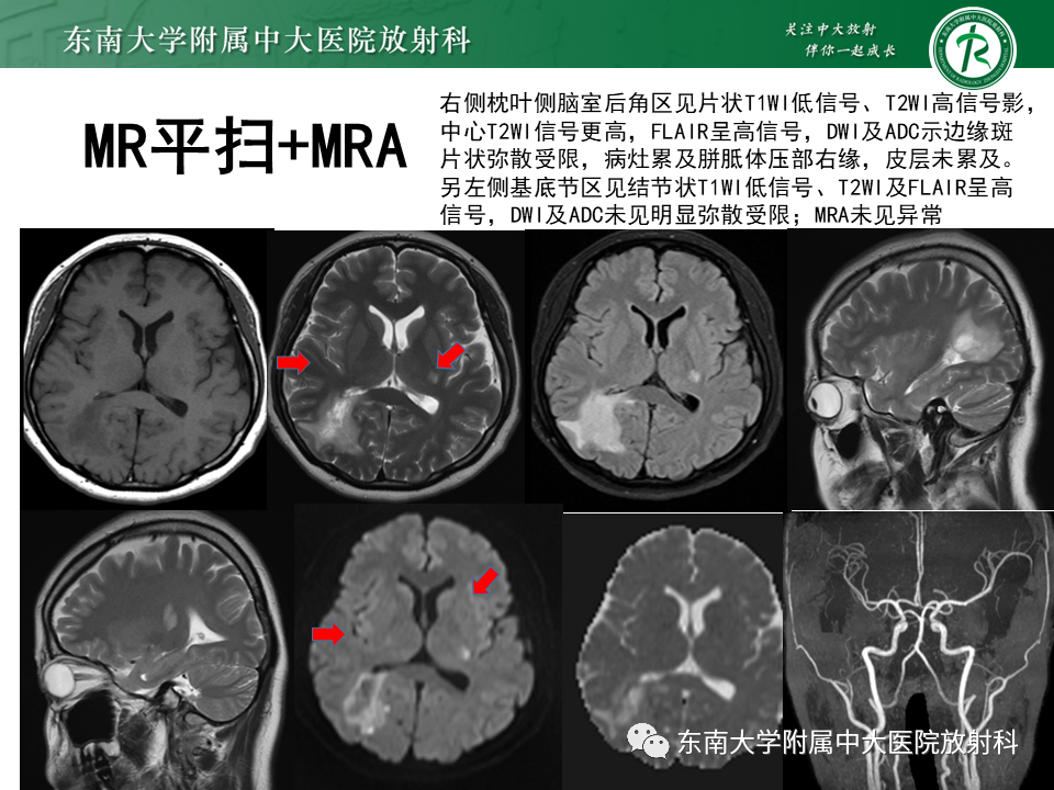 影像PPT - 【PPT】2022.07.08 神经系统疾病——脱髓鞘假瘤-45 影像PPT - 【PPT】2022.07.08 神经系统疾病——脱髓鞘假瘤-45