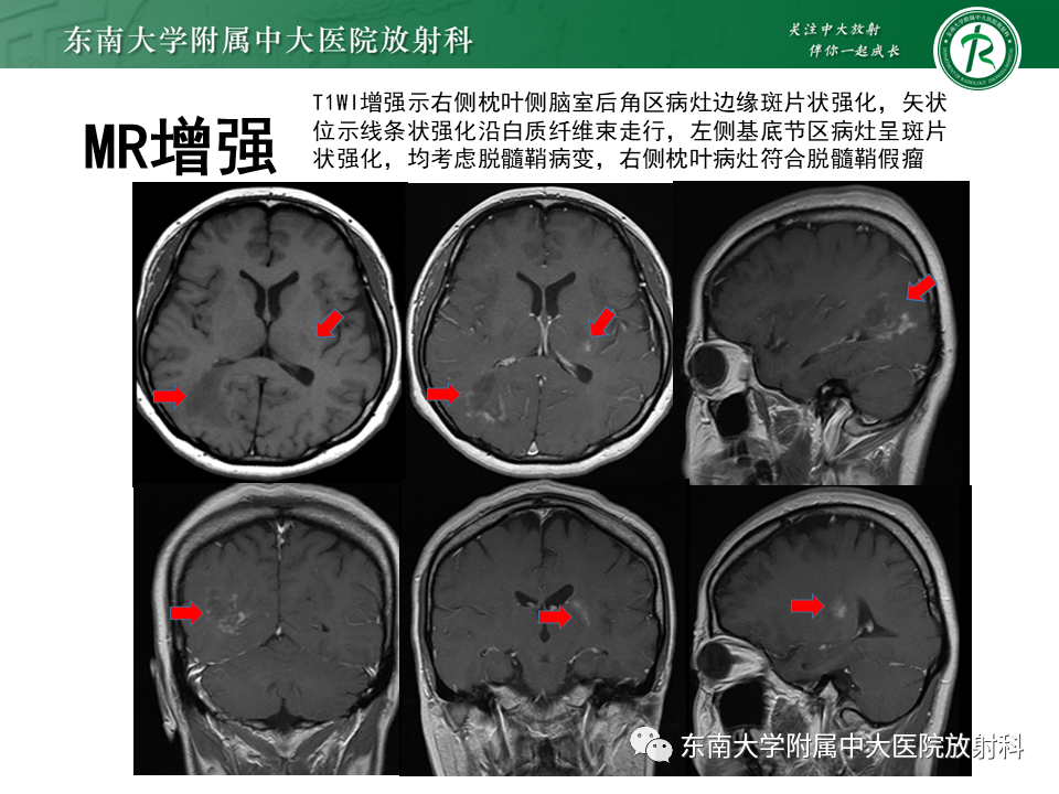 影像PPT - 【PPT】2022.07.08 神经系统疾病——脱髓鞘假瘤-46 影像PPT - 【PPT】2022.07.08 神经系统疾病——脱髓鞘假瘤-46