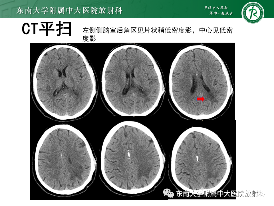 影像PPT - 【PPT】2022.07.08 神经系统疾病——脱髓鞘假瘤-48 影像PPT - 【PPT】2022.07.08 神经系统疾病——脱髓鞘假瘤-48