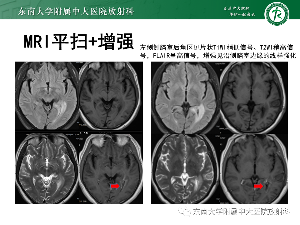 影像PPT - 【PPT】2022.07.08 神经系统疾病——脱髓鞘假瘤-49 影像PPT - 【PPT】2022.07.08 神经系统疾病——脱髓鞘假瘤-49