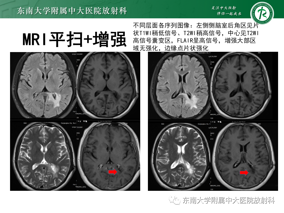影像PPT - 【PPT】2022.07.08 神经系统疾病——脱髓鞘假瘤-50 影像PPT - 【PPT】2022.07.08 神经系统疾病——脱髓鞘假瘤-50