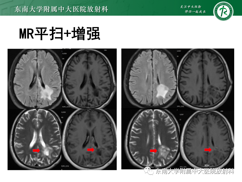 影像PPT - 【PPT】2022.07.08 神经系统疾病——脱髓鞘假瘤-51 影像PPT - 【PPT】2022.07.08 神经系统疾病——脱髓鞘假瘤-51