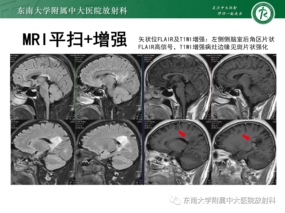 影像PPT - 【PPT】2022.07.08 神经系统疾病——脱髓鞘假瘤-52 影像PPT - 【PPT】2022.07.08 神经系统疾病——脱髓鞘假瘤-52