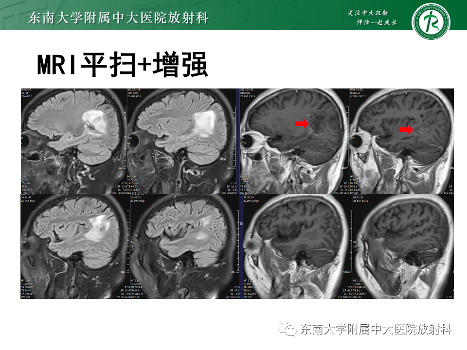 影像PPT - 【PPT】2022.07.08 神经系统疾病——脱髓鞘假瘤-53 影像PPT - 【PPT】2022.07.08 神经系统疾病——脱髓鞘假瘤-53