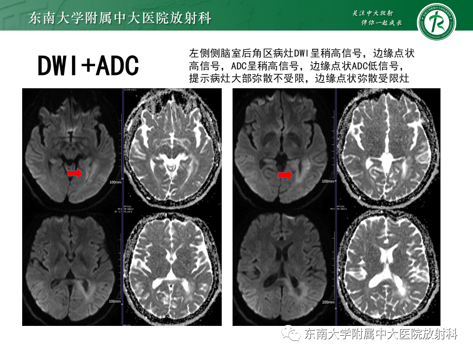 影像PPT - 【PPT】2022.07.08 神经系统疾病——脱髓鞘假瘤-54 影像PPT - 【PPT】2022.07.08 神经系统疾病——脱髓鞘假瘤-54