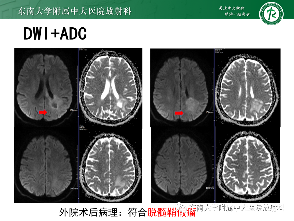 影像PPT - 【PPT】2022.07.08 神经系统疾病——脱髓鞘假瘤-55 影像PPT - 【PPT】2022.07.08 神经系统疾病——脱髓鞘假瘤-55