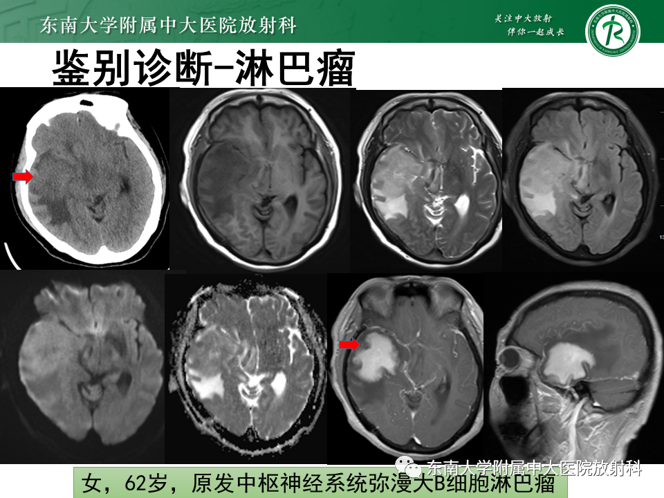 影像PPT - 【PPT】2022.07.08 神经系统疾病——脱髓鞘假瘤-59 影像PPT - 【PPT】2022.07.08 神经系统疾病——脱髓鞘假瘤-59