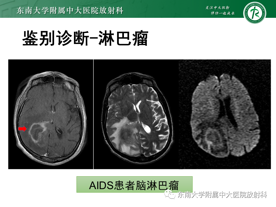 影像PPT - 【PPT】2022.07.08 神经系统疾病——脱髓鞘假瘤-60 影像PPT - 【PPT】2022.07.08 神经系统疾病——脱髓鞘假瘤-60