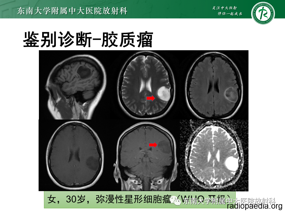 影像PPT - 【PPT】2022.07.08 神经系统疾病——脱髓鞘假瘤-63 影像PPT - 【PPT】2022.07.08 神经系统疾病——脱髓鞘假瘤-63