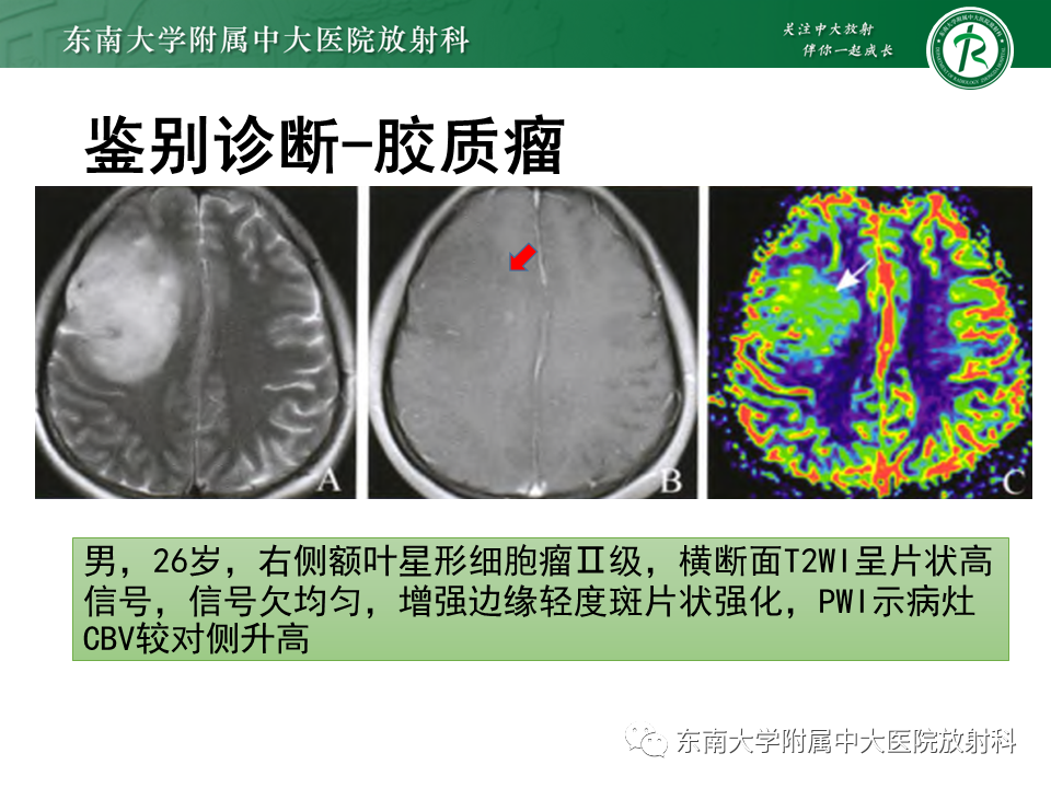影像PPT - 【PPT】2022.07.08 神经系统疾病——脱髓鞘假瘤-64 影像PPT - 【PPT】2022.07.08 神经系统疾病——脱髓鞘假瘤-64