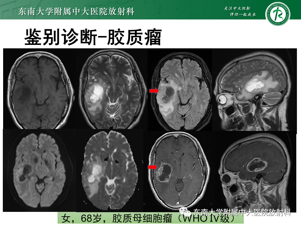 影像PPT - 【PPT】2022.07.08 神经系统疾病——脱髓鞘假瘤-65 影像PPT - 【PPT】2022.07.08 神经系统疾病——脱髓鞘假瘤-65