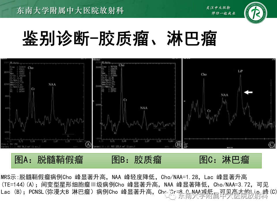 影像PPT - 【PPT】2022.07.08 神经系统疾病——脱髓鞘假瘤-67 影像PPT - 【PPT】2022.07.08 神经系统疾病——脱髓鞘假瘤-67
