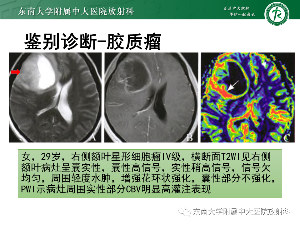 影像PPT - 【PPT】2022.07.08 神经系统疾病——脱髓鞘假瘤-66 影像PPT - 【PPT】2022.07.08 神经系统疾病——脱髓鞘假瘤-66