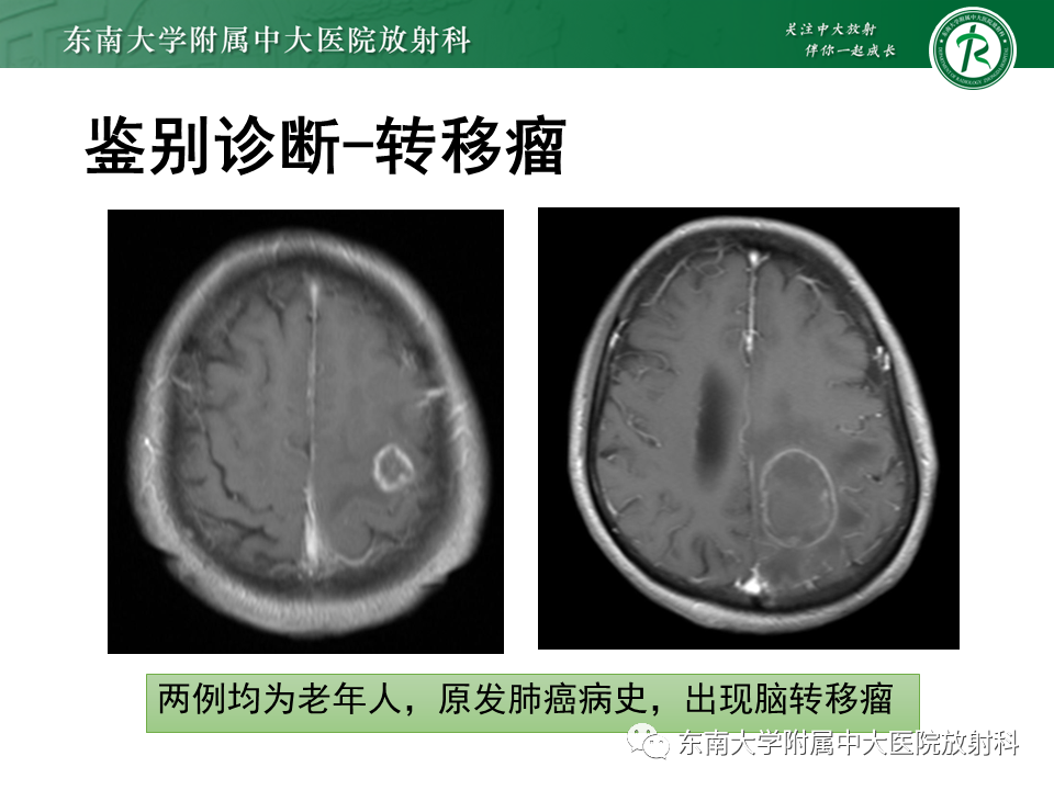 影像PPT - 【PPT】2022.07.08 神经系统疾病——脱髓鞘假瘤-70 影像PPT - 【PPT】2022.07.08 神经系统疾病——脱髓鞘假瘤-70