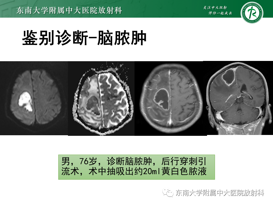 影像PPT - 【PPT】2022.07.08 神经系统疾病——脱髓鞘假瘤-73 影像PPT - 【PPT】2022.07.08 神经系统疾病——脱髓鞘假瘤-73