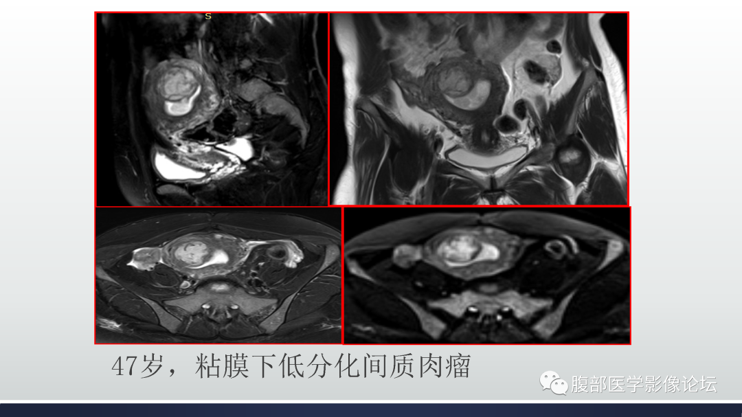 影像PPT - 【病例】子宫内膜样腺癌1例MR-18