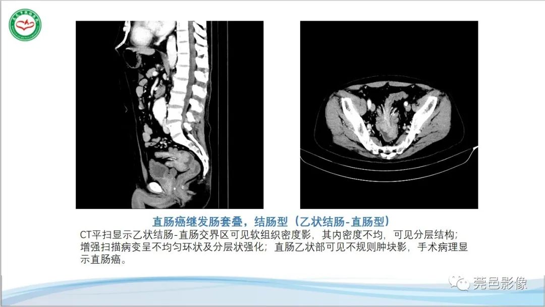 影像PPT - 【PPT】肠套叠的影像诊断-2
