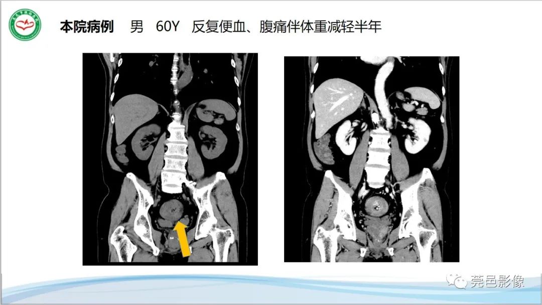 影像PPT - 【PPT】肠套叠的影像诊断-1