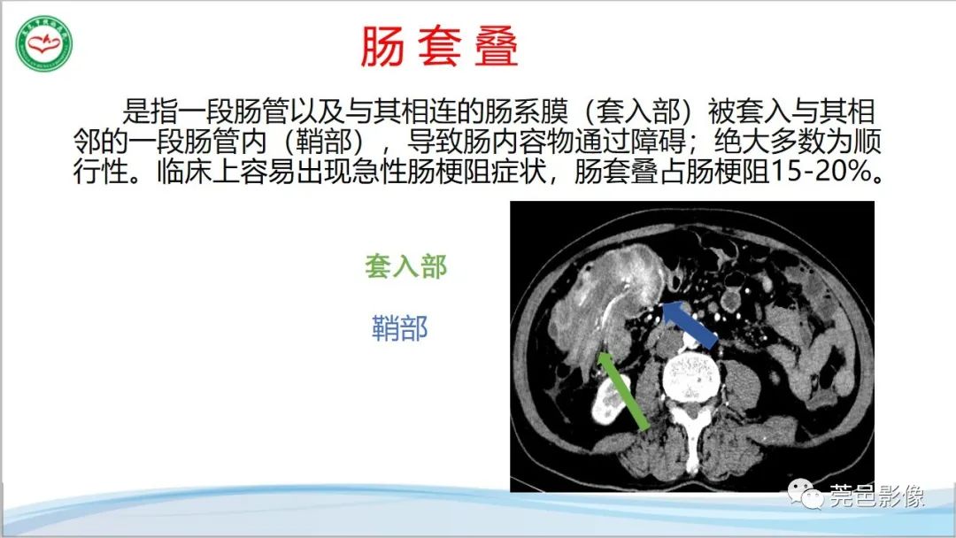 影像PPT - 【PPT】肠套叠的影像诊断-5