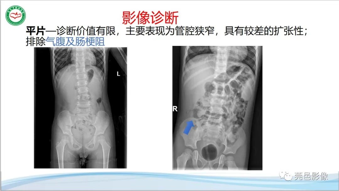 影像PPT - 【PPT】肠套叠的影像诊断-9