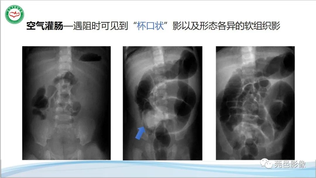 影像PPT - 【PPT】肠套叠的影像诊断-10