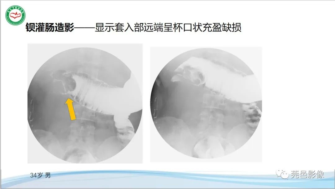 影像PPT - 【PPT】肠套叠的影像诊断-11