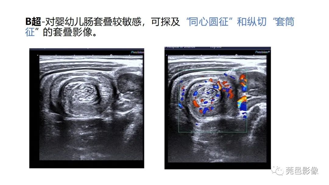 影像PPT - 【PPT】肠套叠的影像诊断-13