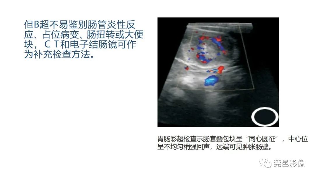 影像PPT - 【PPT】肠套叠的影像诊断-15