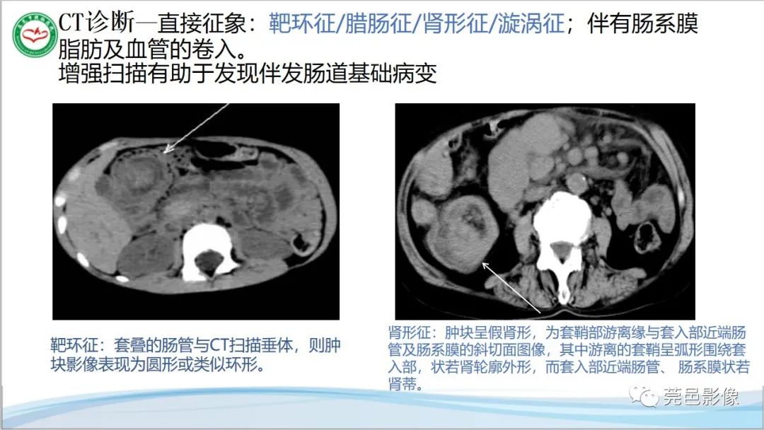 影像PPT - 【PPT】肠套叠的影像诊断-16