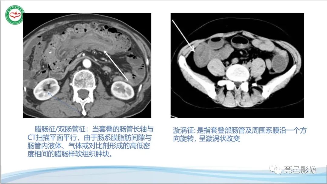 影像PPT - 【PPT】肠套叠的影像诊断-17