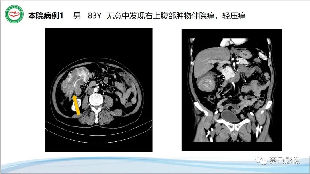 影像PPT - 【PPT】肠套叠的影像诊断-19