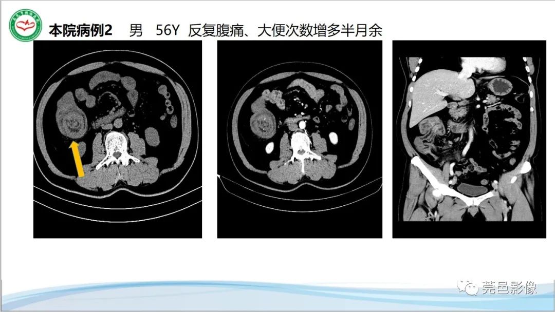 影像PPT - 【PPT】肠套叠的影像诊断-20