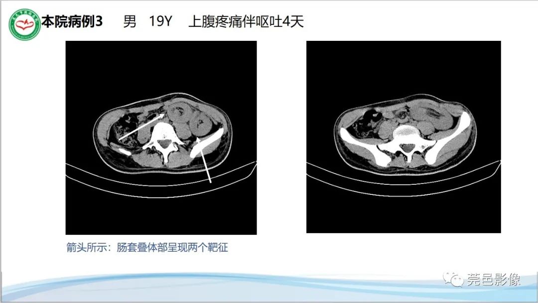 影像PPT - 【PPT】肠套叠的影像诊断-21