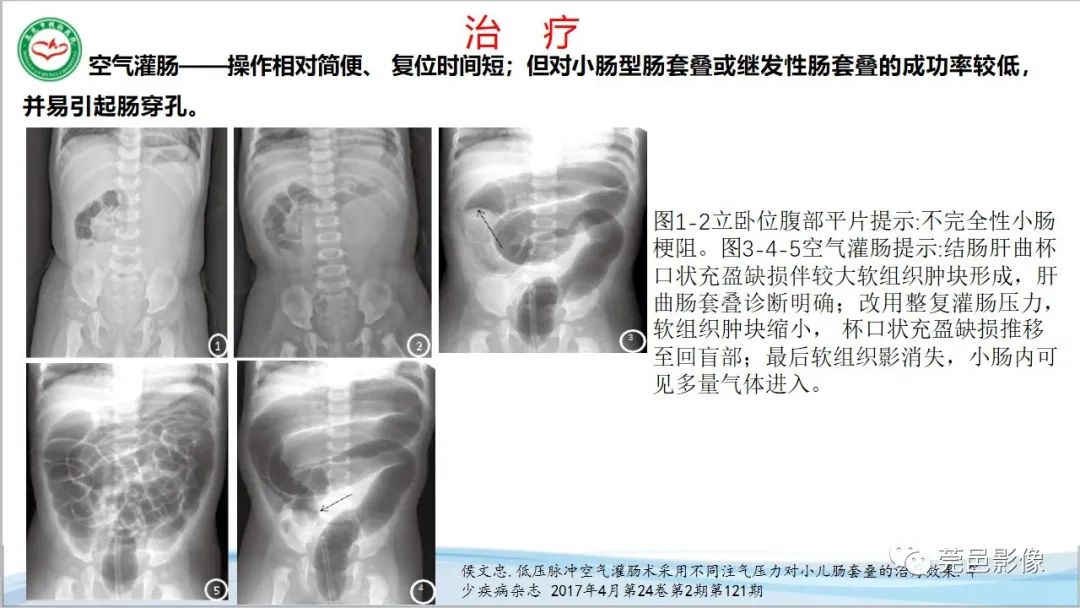 影像PPT - 【PPT】肠套叠的影像诊断-23