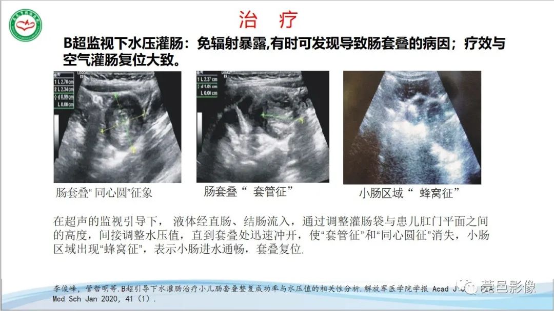 影像PPT - 【PPT】肠套叠的影像诊断-24