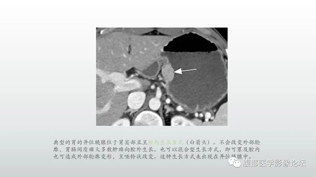 影像PPT - 【PPT】异位胰腺影像诊断-9