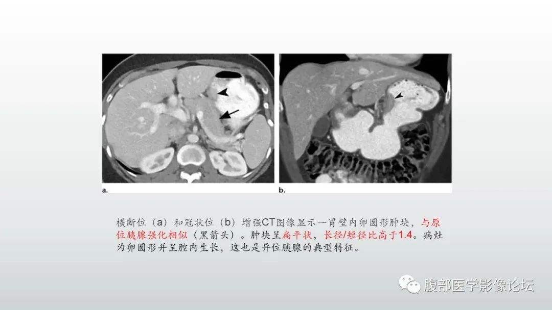 影像PPT - 【PPT】异位胰腺影像诊断-10