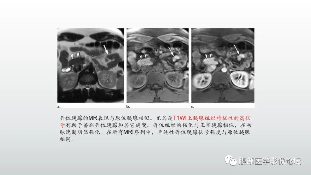 影像PPT - 【PPT】异位胰腺影像诊断-11