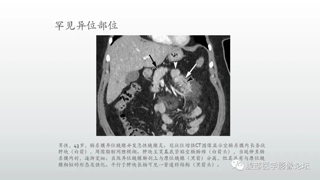 影像PPT - 【PPT】异位胰腺影像诊断-12