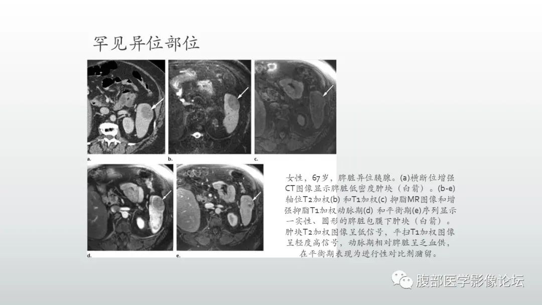 影像PPT - 【PPT】异位胰腺影像诊断-13