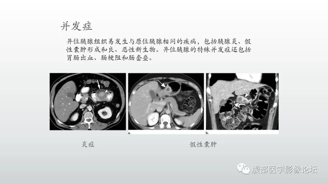 影像PPT - 【PPT】异位胰腺影像诊断-14