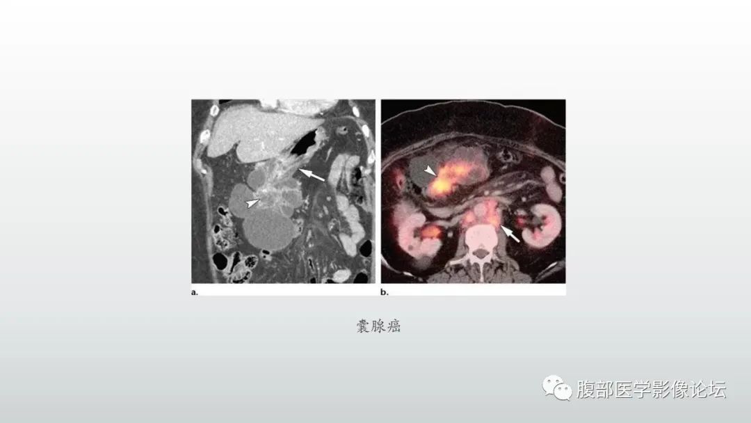 影像PPT - 【PPT】异位胰腺影像诊断-15
