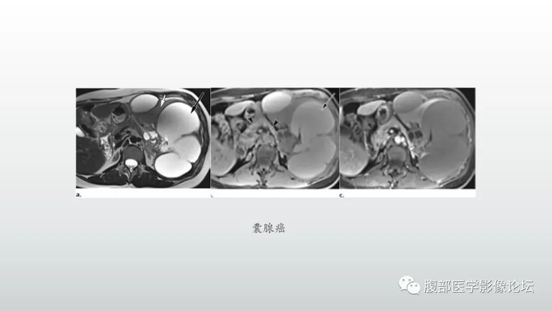 影像PPT - 【PPT】异位胰腺影像诊断-16