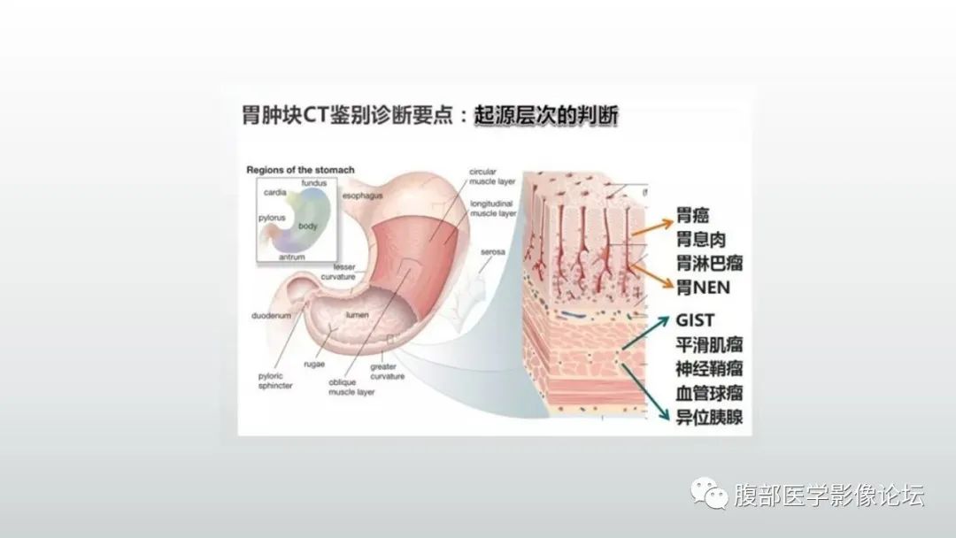 影像PPT - 【PPT】异位胰腺影像诊断-18