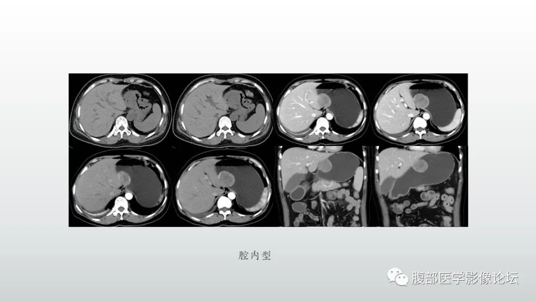 影像PPT - 【PPT】异位胰腺影像诊断-20