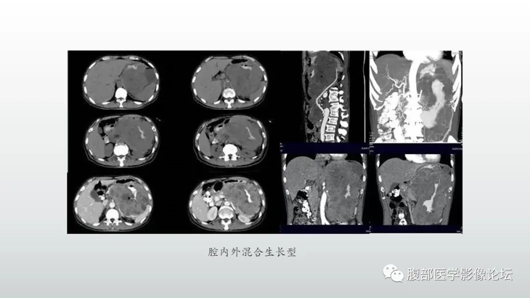 影像PPT - 【PPT】异位胰腺影像诊断-21