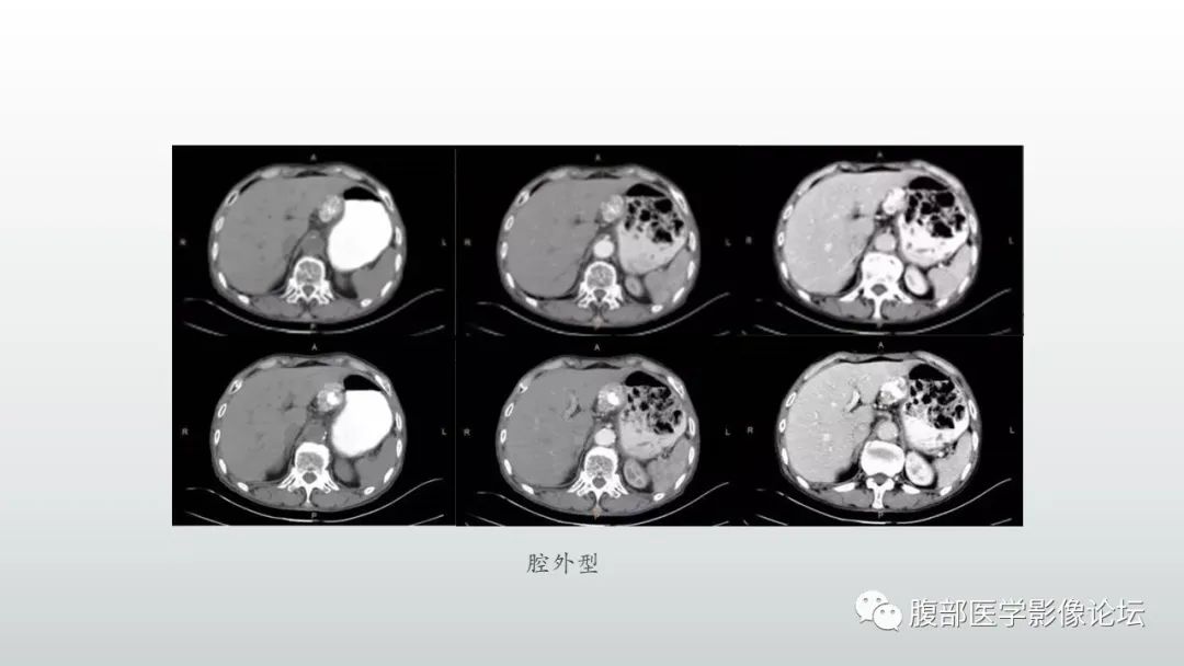 影像PPT - 【PPT】异位胰腺影像诊断-22